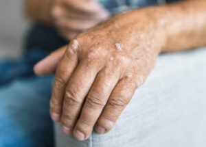 16 Psoriatic Arthritis Treatments, Remedies, And Reliefs