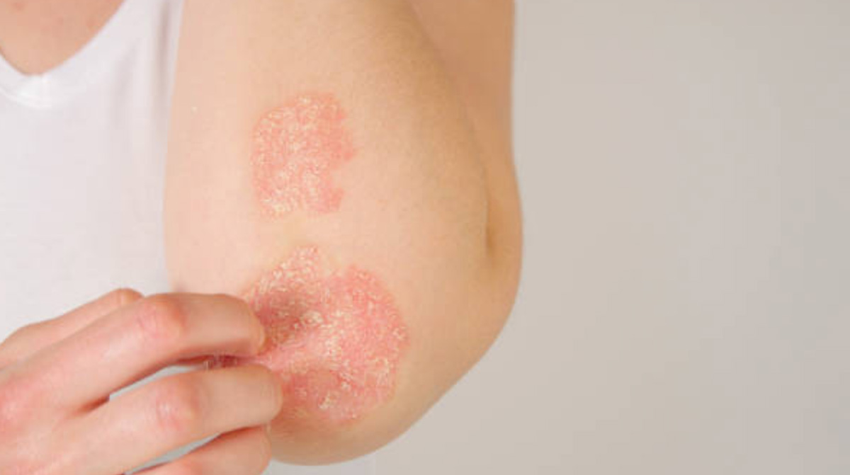 Eczema Atopic Dermatitis Treatments Symptoms And Causes