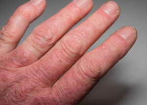 Psoriatic Arthritis (PsA) Symptoms, Signs, Causes, And Treatments