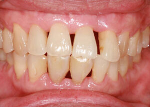 Gum Disease Treatments, Remedies, And Care