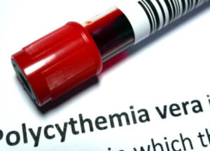 Polycythemia Vera Causes, Symptoms, Signs, And Treatments