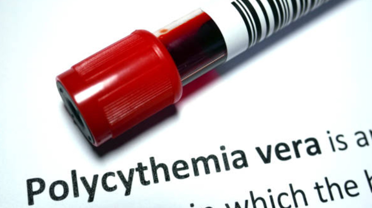 Polycythemia Vera Causes, Symptoms, Signs, And Treatments | Page 2 Of 4