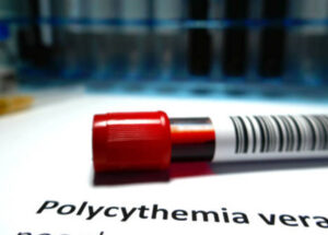 15 Polycythemia Vera Treatments And Care