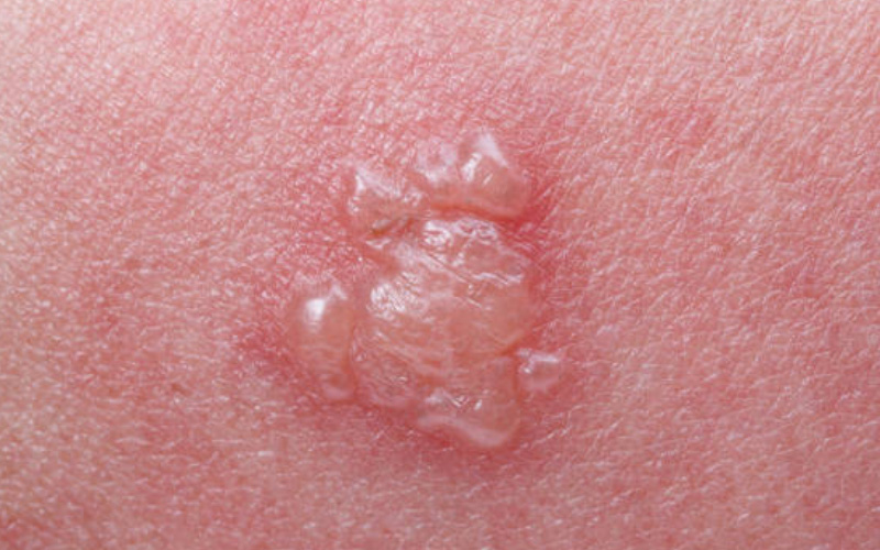 eczema-blisters