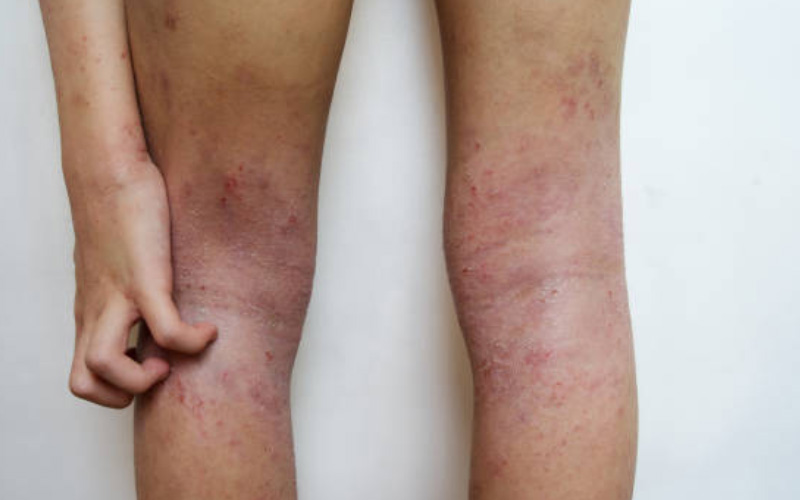 eczema-lesions2