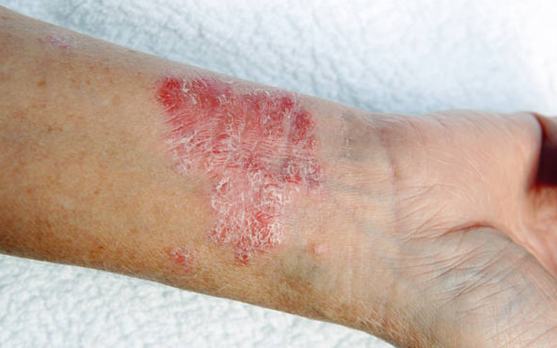 eczema-redness