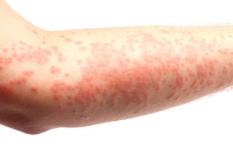 eczema-swollen-skin-redness2