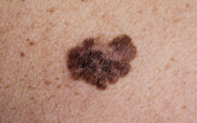 melanoma skin cancer photographs 1