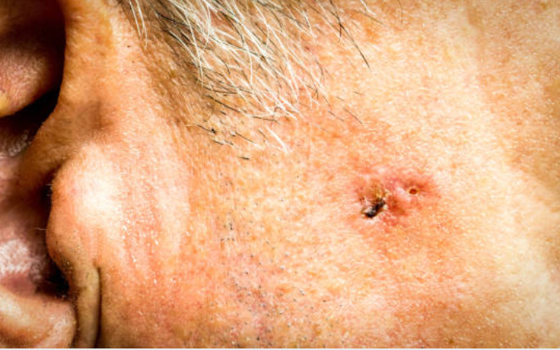 melanoma skin cancer photographs 3