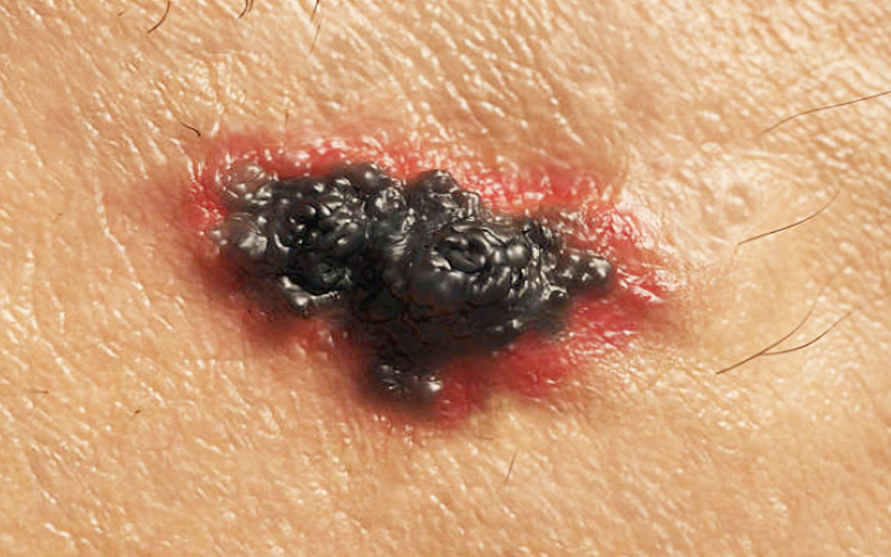 melanoma skin cancer photographs 4