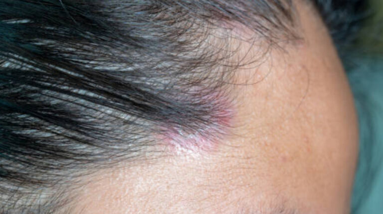 Scalp Psoriasis Symptoms, Signs, Causes, Remedies, And Treatments