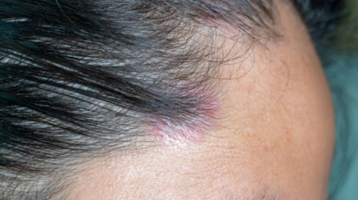 Scalp Psoriasis Symptoms Signs Causes Remedies And Treatments