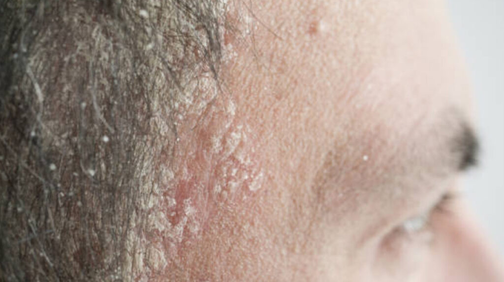 Scalp Psoriasis Symptoms, Signs, Causes, Remedies, And Treatments