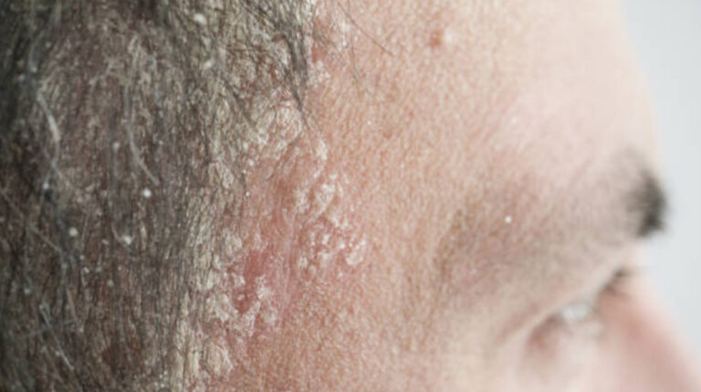 Scalp Psoriasis Symptoms, Signs, Causes, Remedies, And Treatments