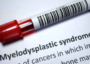 Myelodysplastic Syndrome (MDS) Symptoms, Signs, Causes, And Treatments