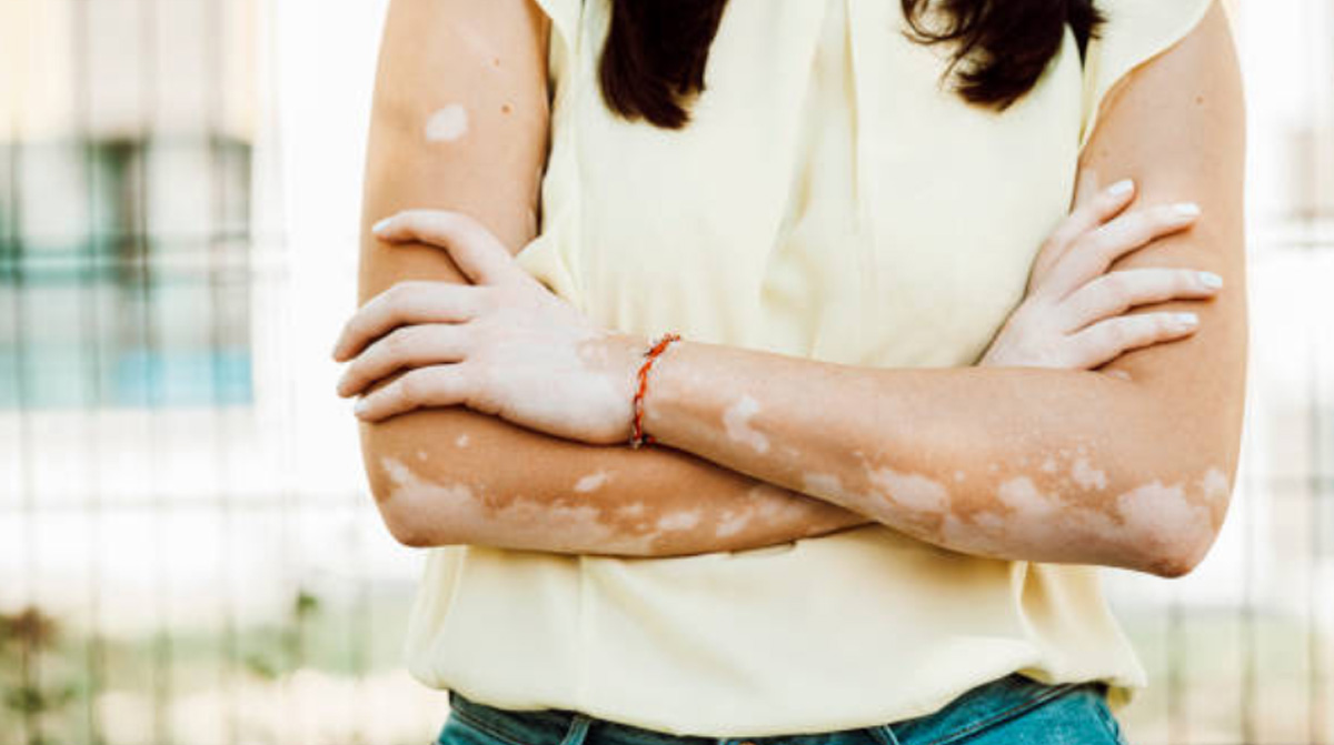 Vitiligo Treatments, Care, Symptoms, And Causes